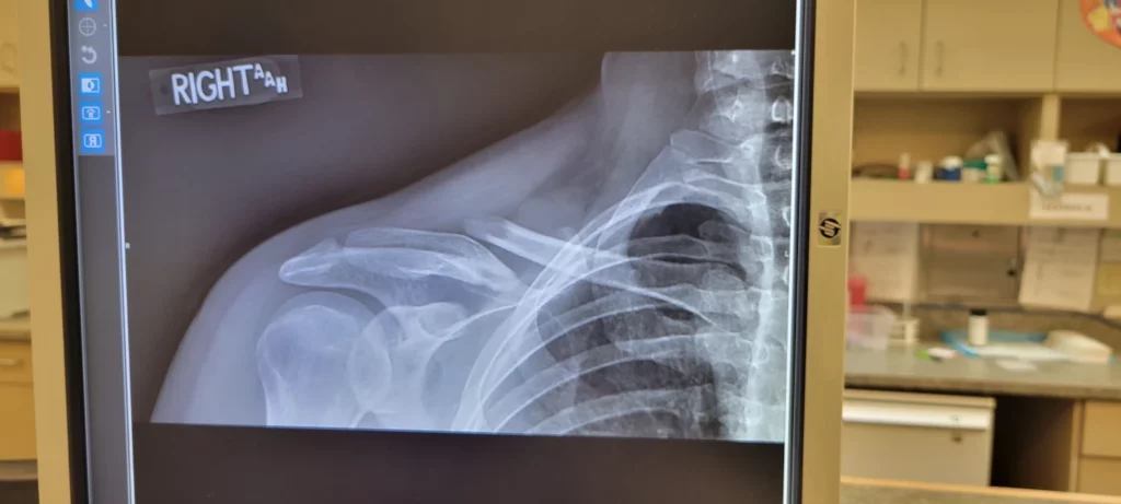 collarbone fracture